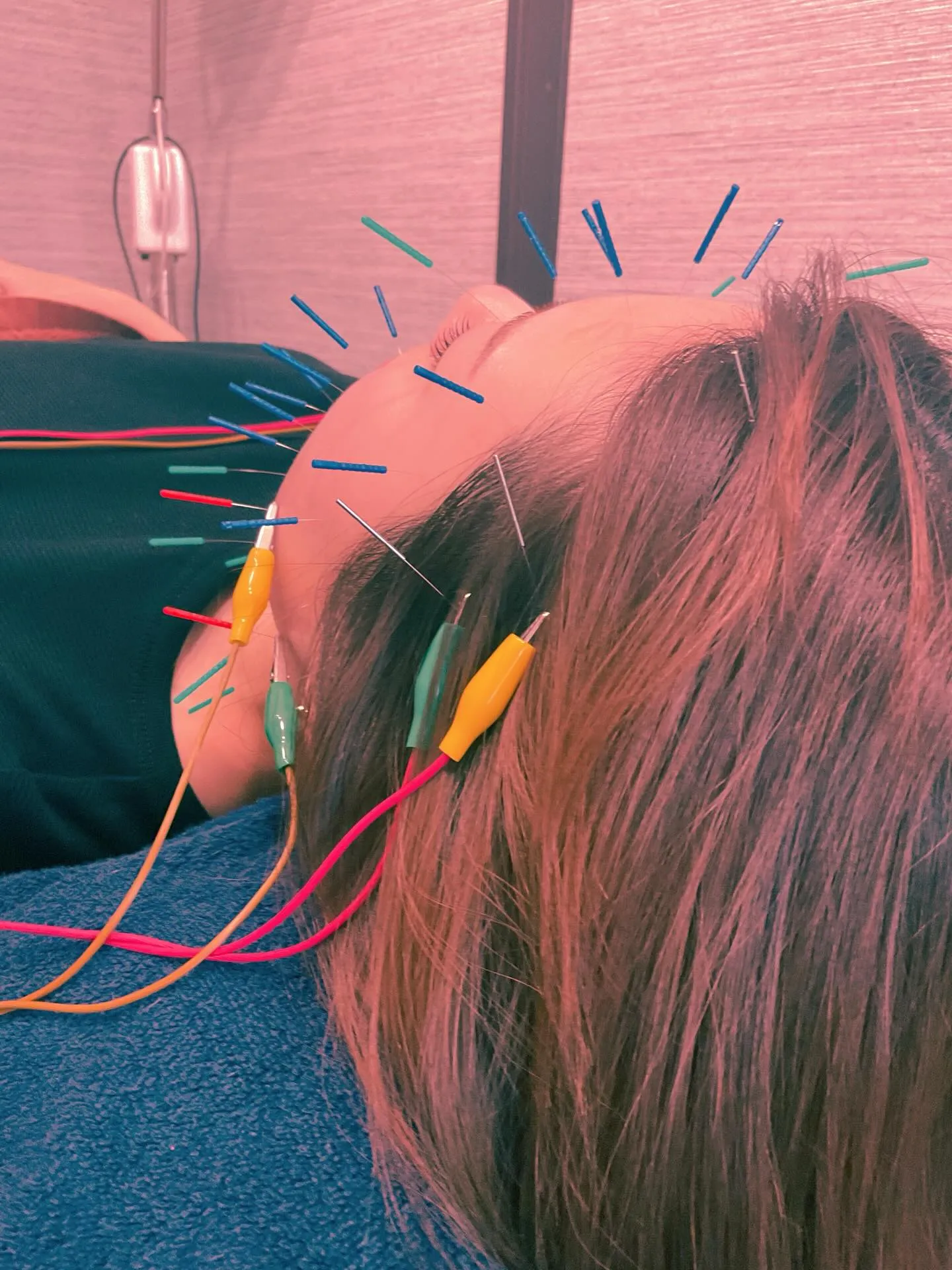 美容鍼パルスあり❤️