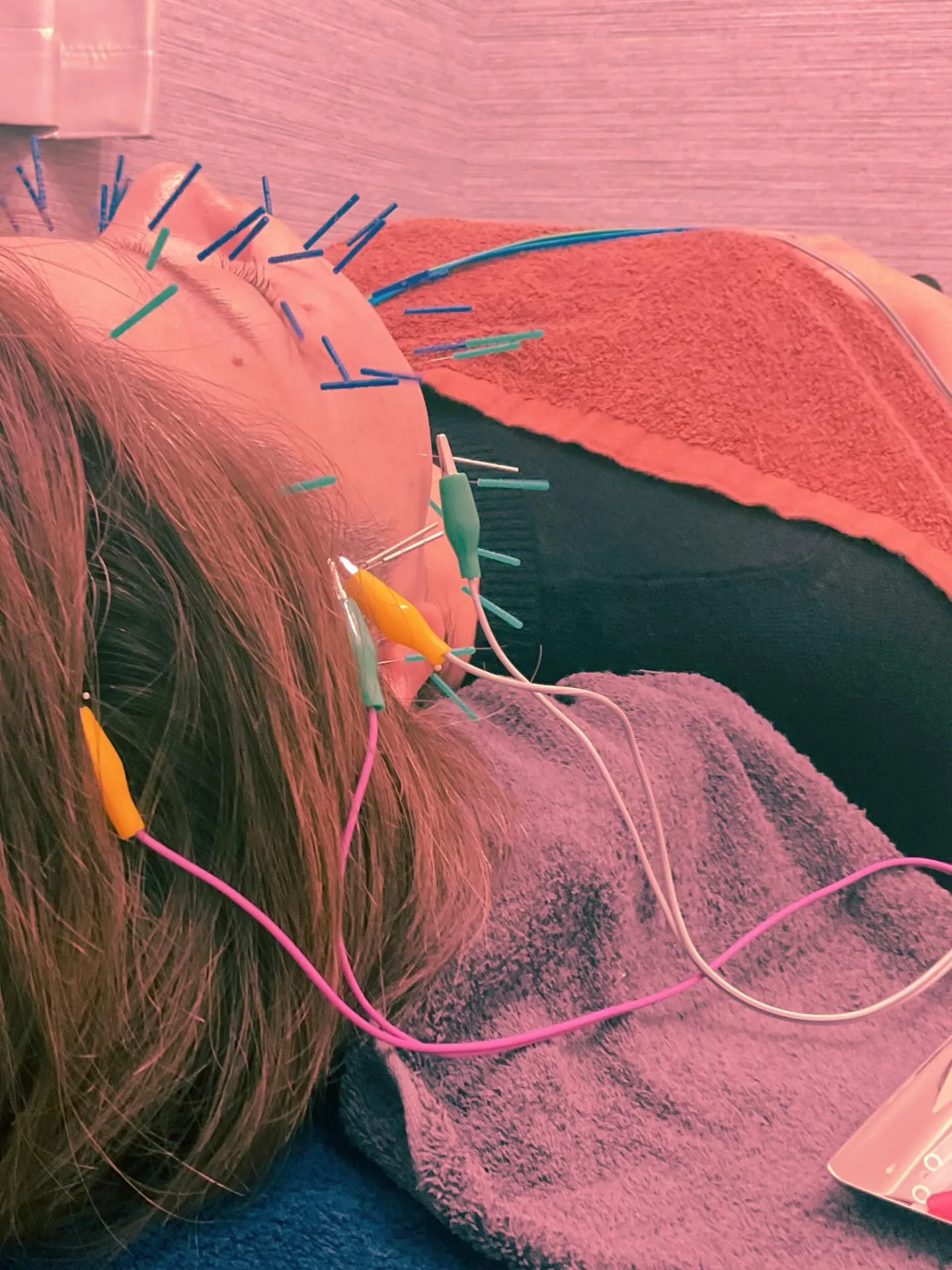 美容鍼パルスあり🌟