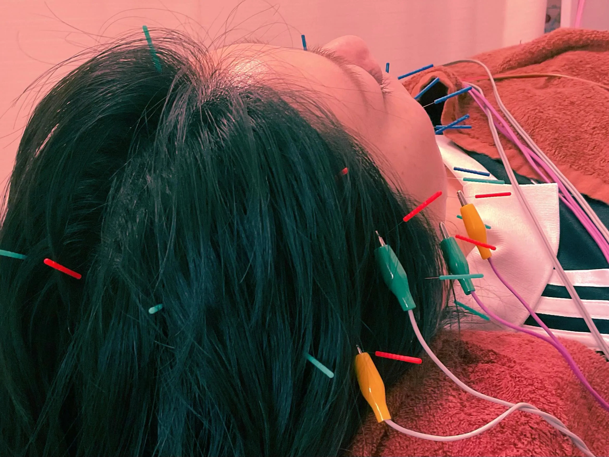 パルス美容鍼🌸